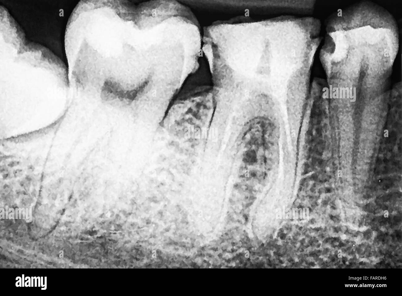 Füllung des Wurzelkanals Systeme auf Zähne Röntgen Stockfoto