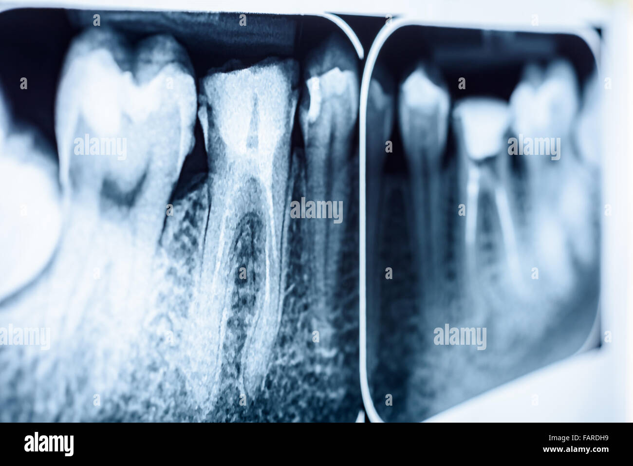 Füllung des Wurzelkanals Systeme auf Zähne Röntgen Stockfoto