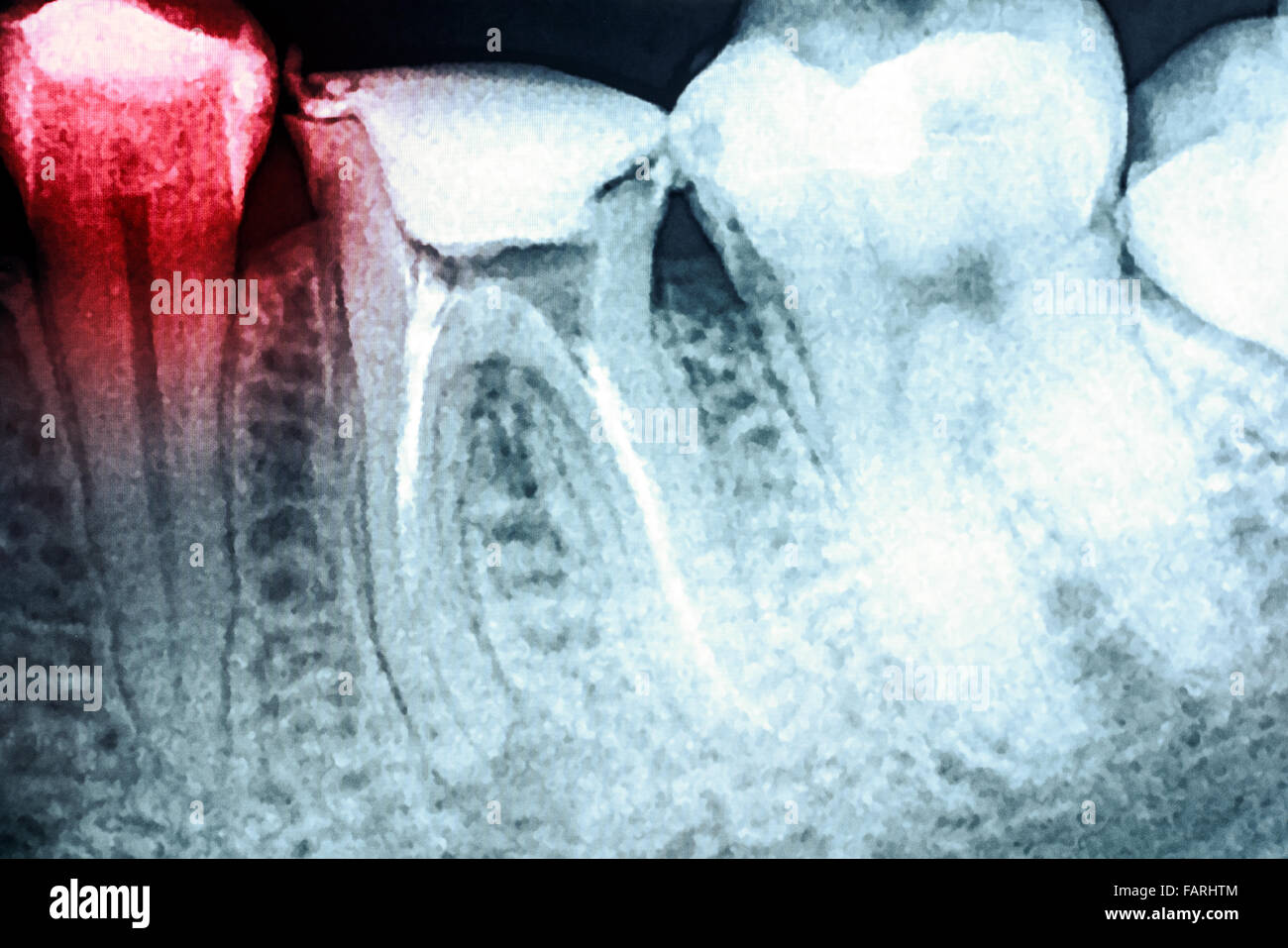 Schmerzen von Karies auf Zähne Röntgen Stockfoto