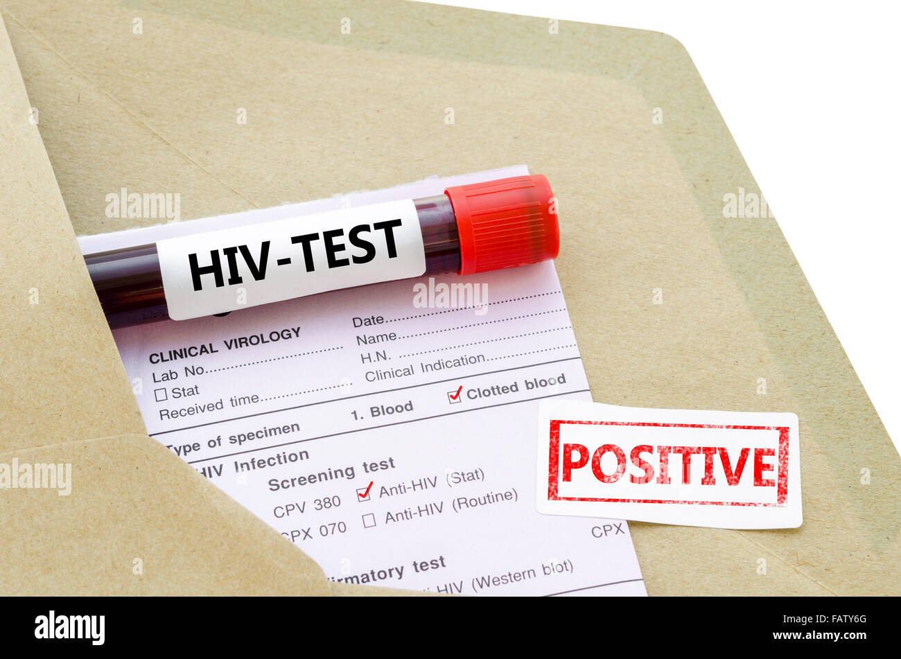 Blutprobe mit HIV-Test positiv und Labor Anfrageformular auf weißem Hintergrund. Stockfoto