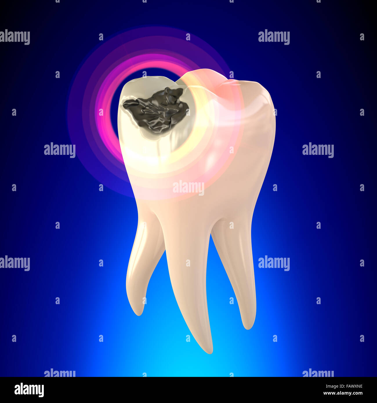 Molar Zahn mit Karies Stockfoto