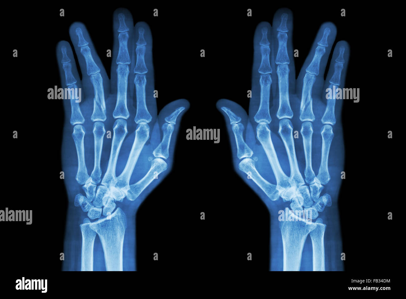 Fraktur-Welle der proximalen Phalanx der Ringfinger (Film Röntgen beider Hand-AP) Stockfoto