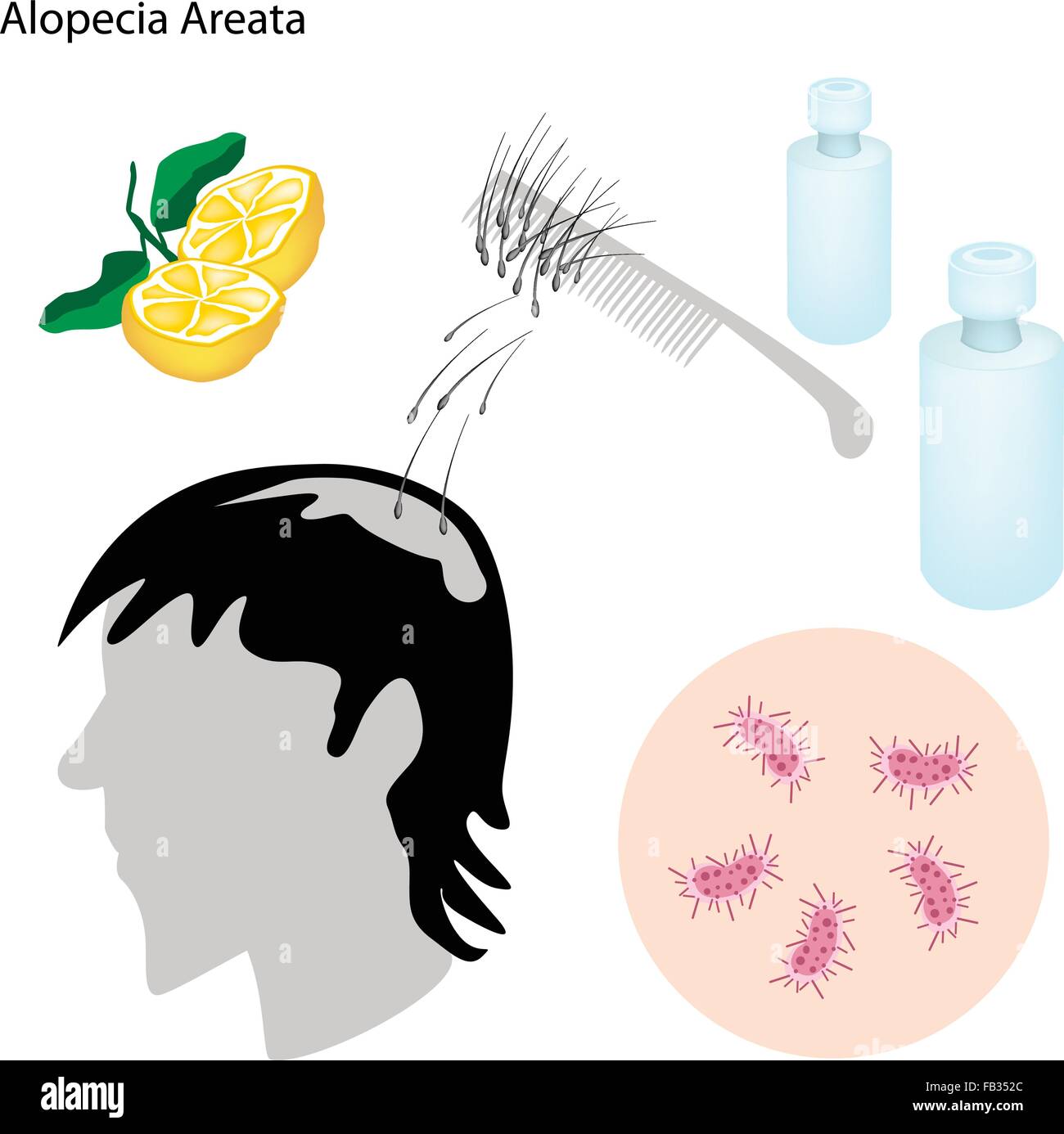 Medizinisches Konzept, Illustration von Alopecia Areata oder Haarausfall mit medizinischen Prävention und Behandlung. Stock Vektor