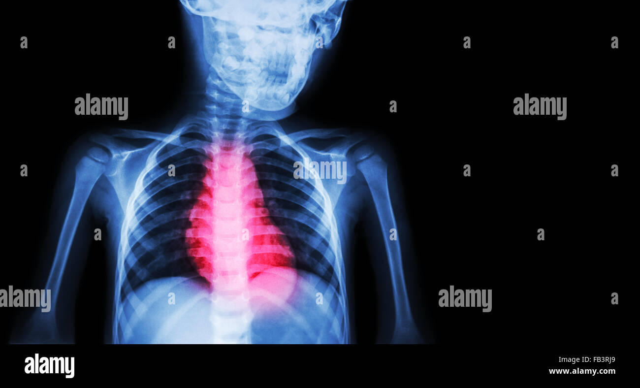 Ischämische Herzkrankheit, Myokardinfarkt (MI) (Film x-ray Körper Menschen mit Herz-Kreislauferkrankungen und leeren Bereich auf der rechten Seite Stockfoto