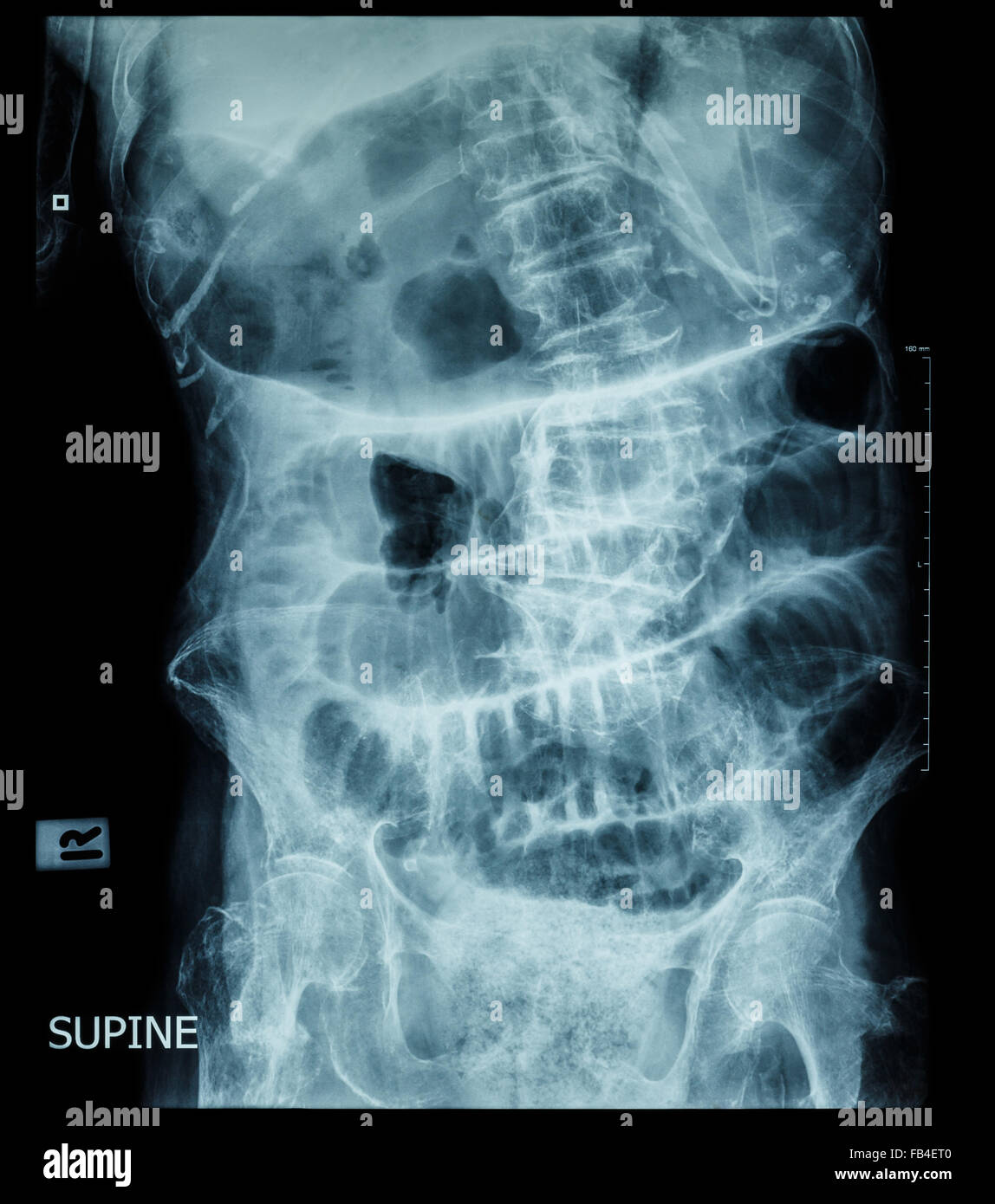 Kleinen Darmverschluss (Film Röntgen-Abdomen (Rückenlage): Show Dünndarm und Magen dehnen) (Leiter Schrittmuster) Stockfoto