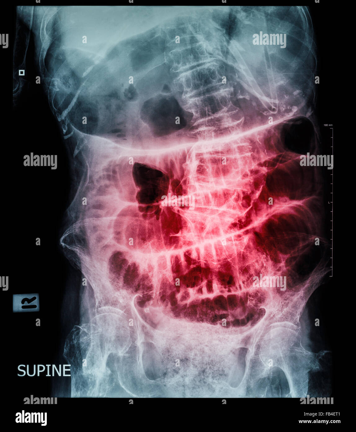 Kleinen Darmverschluss (Film Röntgen-Abdomen (Rückenlage): Show Dünndarm und Magen dehnen) (Leiter Schrittmuster) Stockfoto