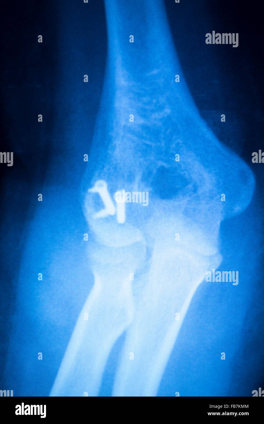 Othopedics und Unfallchirurgie chirurgische Implantat Arm und Ellenbogen Xray Scan Testergebnisse zeigen Metall Titanplatte und Schrauben. Stockfoto