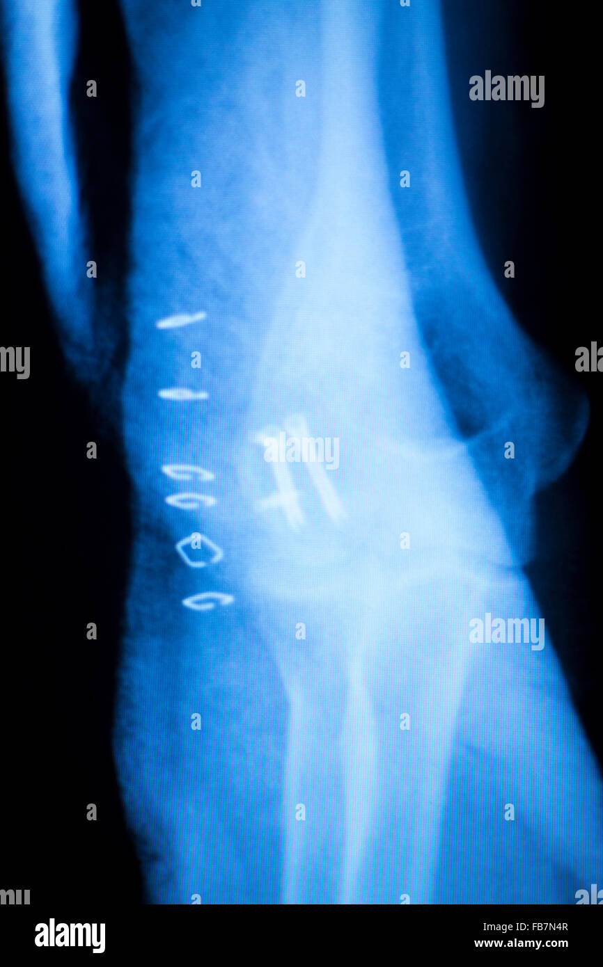 Othopedics und Unfallchirurgie chirurgische Implantat Arm und Ellenbogen Xray Scan Testergebnisse zeigen Metall Titanplatte und Schrauben. Stockfoto