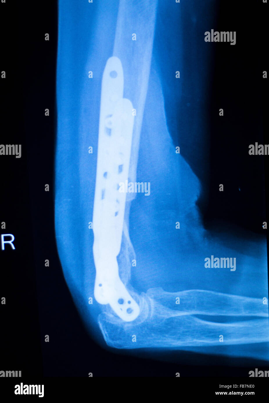 Othopedics und Unfallchirurgie chirurgische Implantat Arm und Ellenbogen Xray Scan Testergebnisse zeigen Metall Titanplatte und Schrauben. Stockfoto