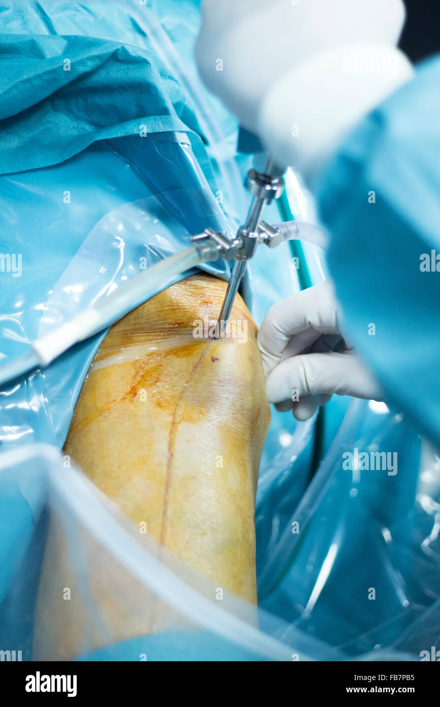 Bestes Krankenhaus Für Knie-op In Essen Knie Arthroskopie orthopädische Chirurgie Operation im Krankenhaus