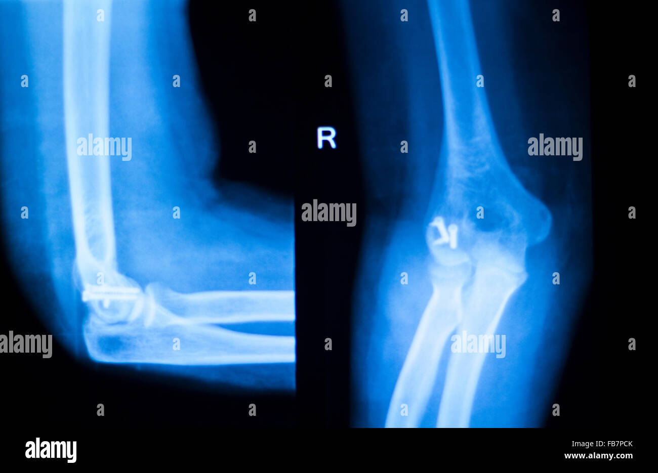 Othopedics und Unfallchirurgie chirurgische Implantat Arm und Ellenbogen Xray Scan Testergebnisse zeigen Metall Titanplatte und Schrauben. Stockfoto