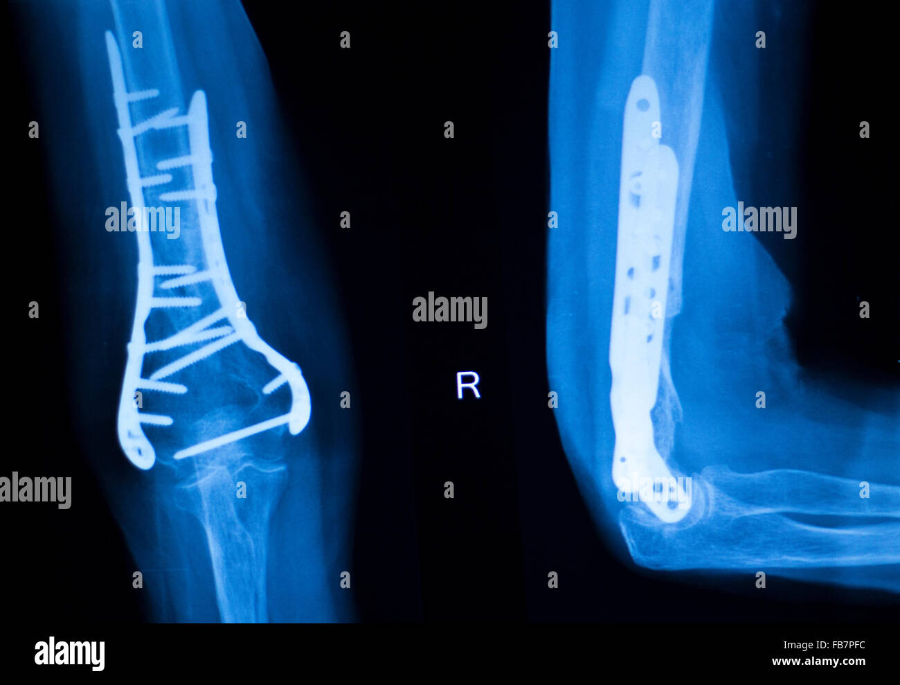 Othopedics und Unfallchirurgie chirurgische Implantat Arm und Ellenbogen  Xray Scan Testergebnisse zeigen Metall Titanplatte und Schrauben  Stockfotografie - Alamy