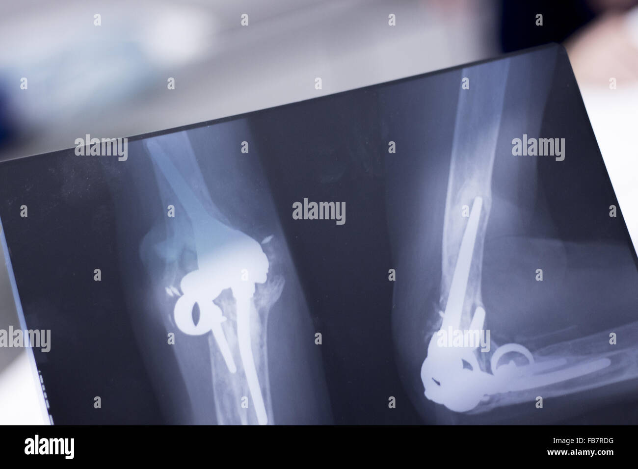 Othopedics und Unfallchirurgie chirurgische Implantat Arm und Ellenbogen Xray Scan Testergebnisse zeigen Metall Titanplatte und Schrauben. Stockfoto