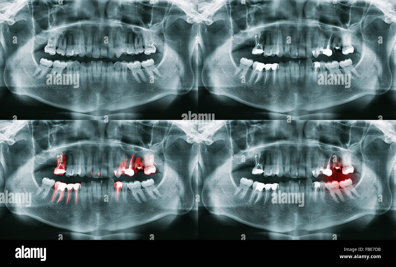 Viele Panorama Zahnröntgen. Kiefer mit Problem und nicht. Stockfoto
