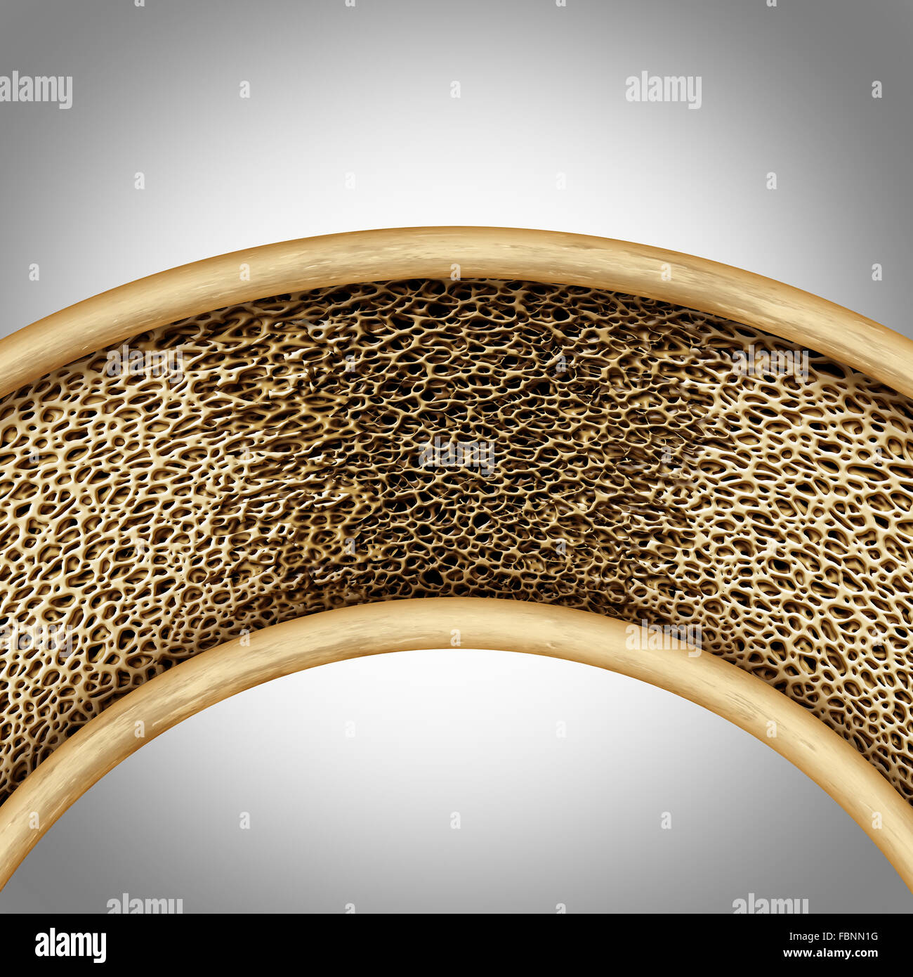 Knochen Krankheitskonzept mit Osteomalazie oder Osteoperosis als Medizin Anatomie Symbol als eine Schwächung und deformierte Skelett Schwammgewebe mit porösen schwach Skelett-Struktur durch Erweichung der Knochen. Stockfoto