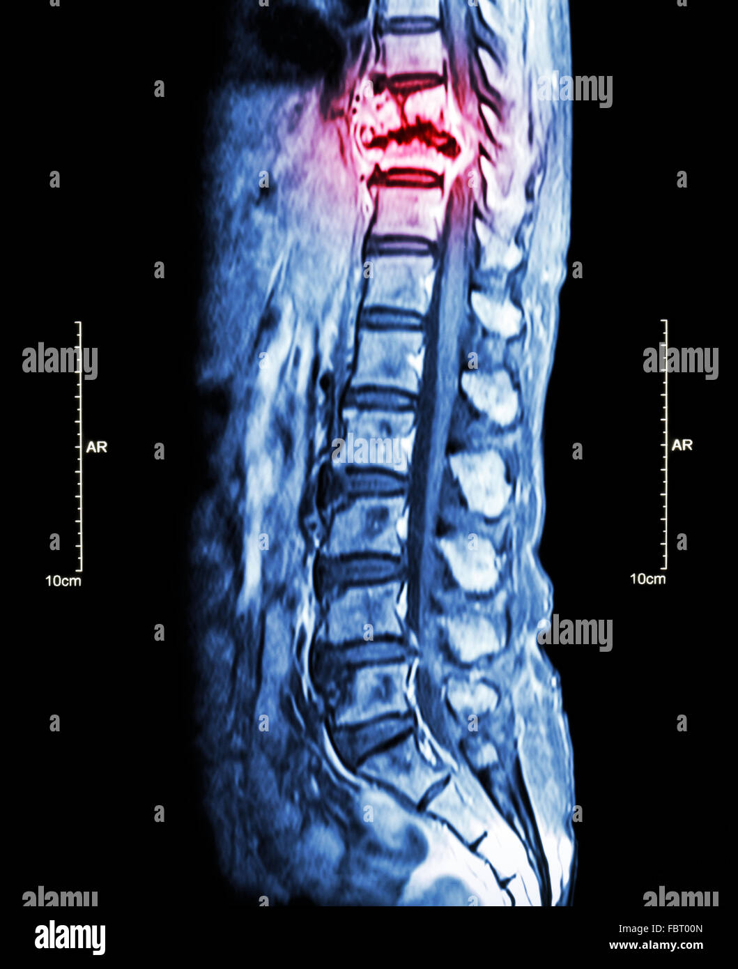 Wirbelsäule Metastasen (Krebs zu verbreiten, Brustwirbelsäule) (MRI der Brust-und Lendenwirbelsäule: zeigen Brustwirbelsäule Metastasierung und com Stockfoto