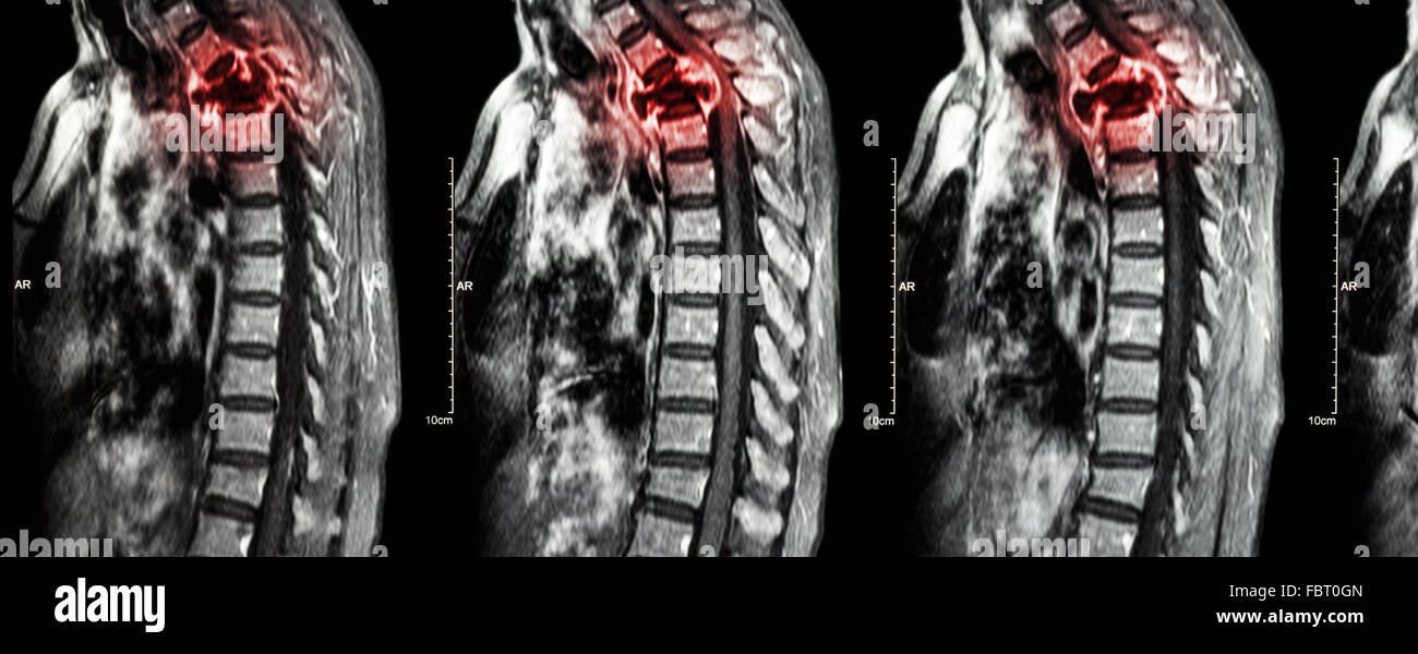 Wirbelsäule Metastasen (Krebs zu verbreiten, Brustwirbelsäule) (MRI des zervikalen und thorakalen Wirbelsäule: Brustwirbelsäule Metastasierung und c zeigen Stockfoto
