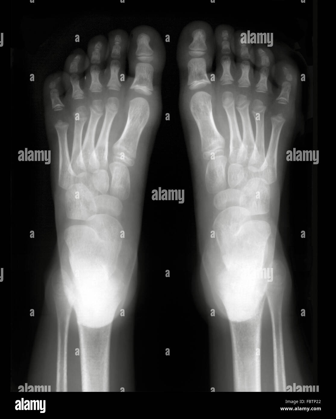 Fuß-xray Stockfoto