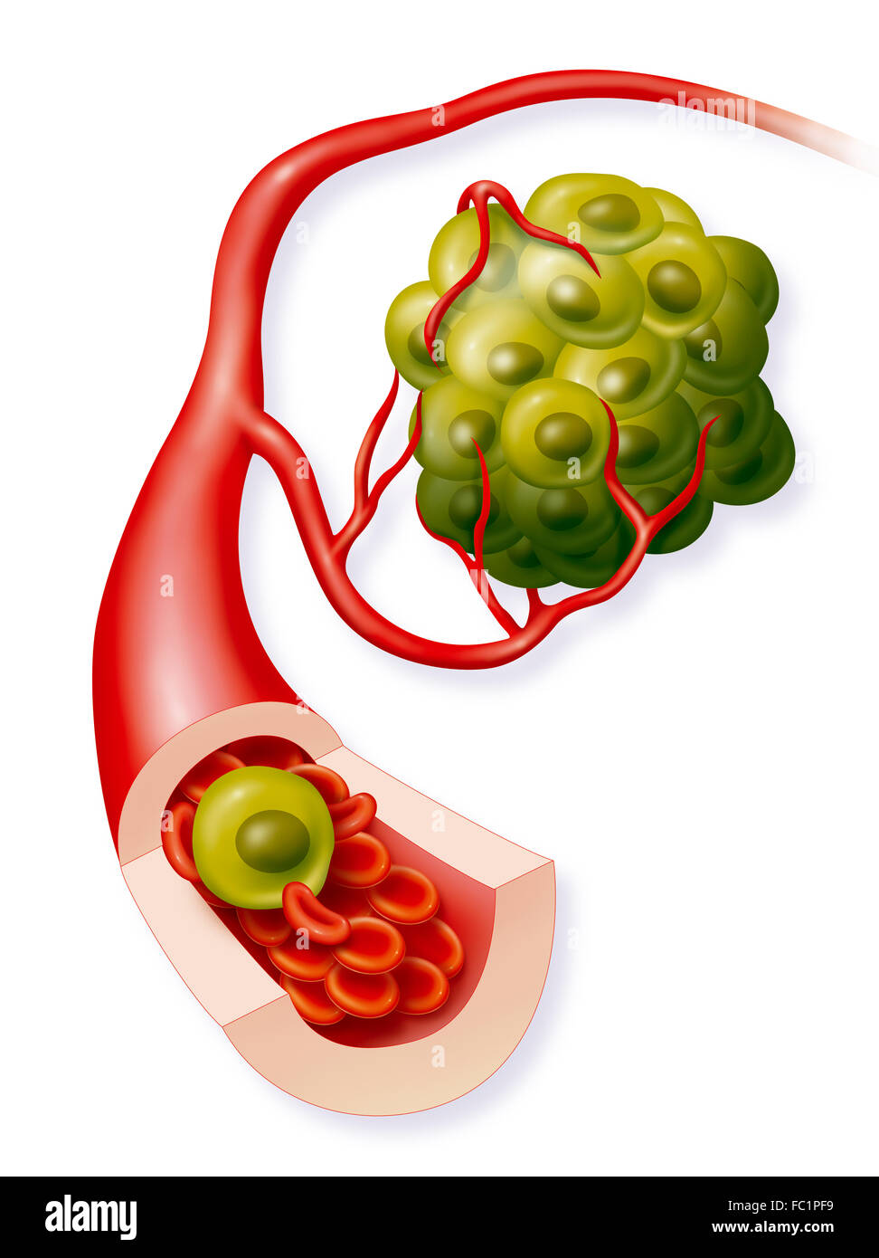 TUMOR, ZEICHNUNG Stockfoto