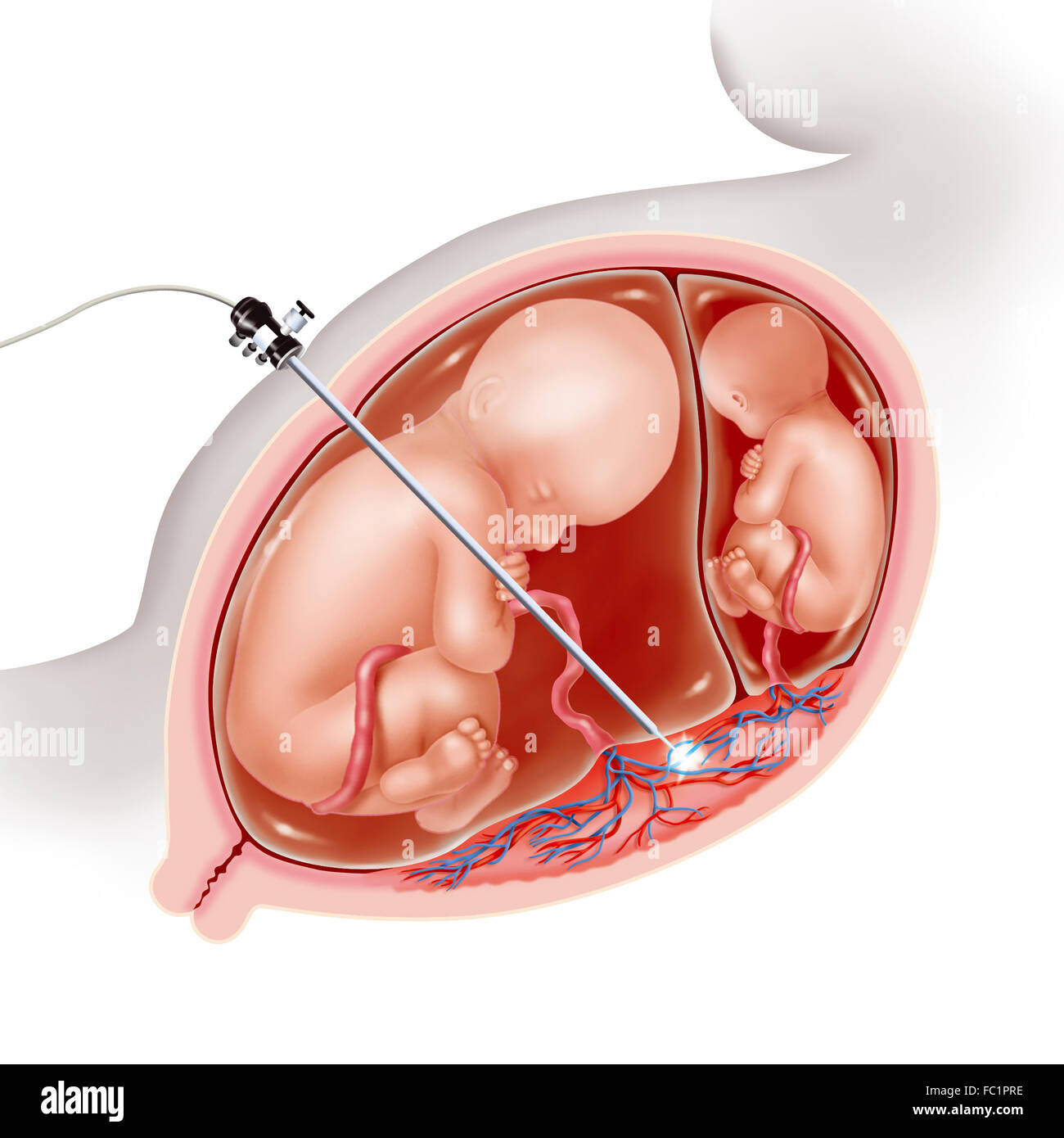 twin twin transfusion syndrome stockfoto bild 93467570 alamy twin twin transfusion