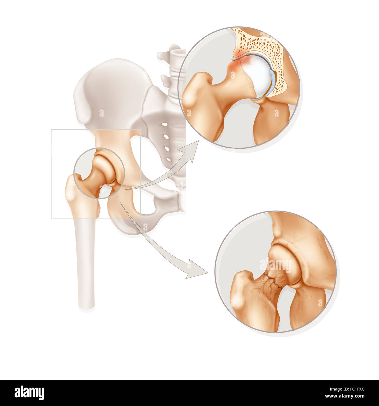 HIP-PATHOLOGIE Stockfoto