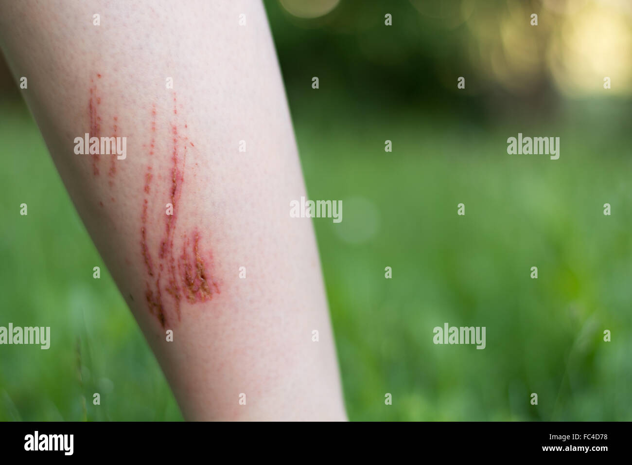 Verletzungen am Unterarm Stockfoto