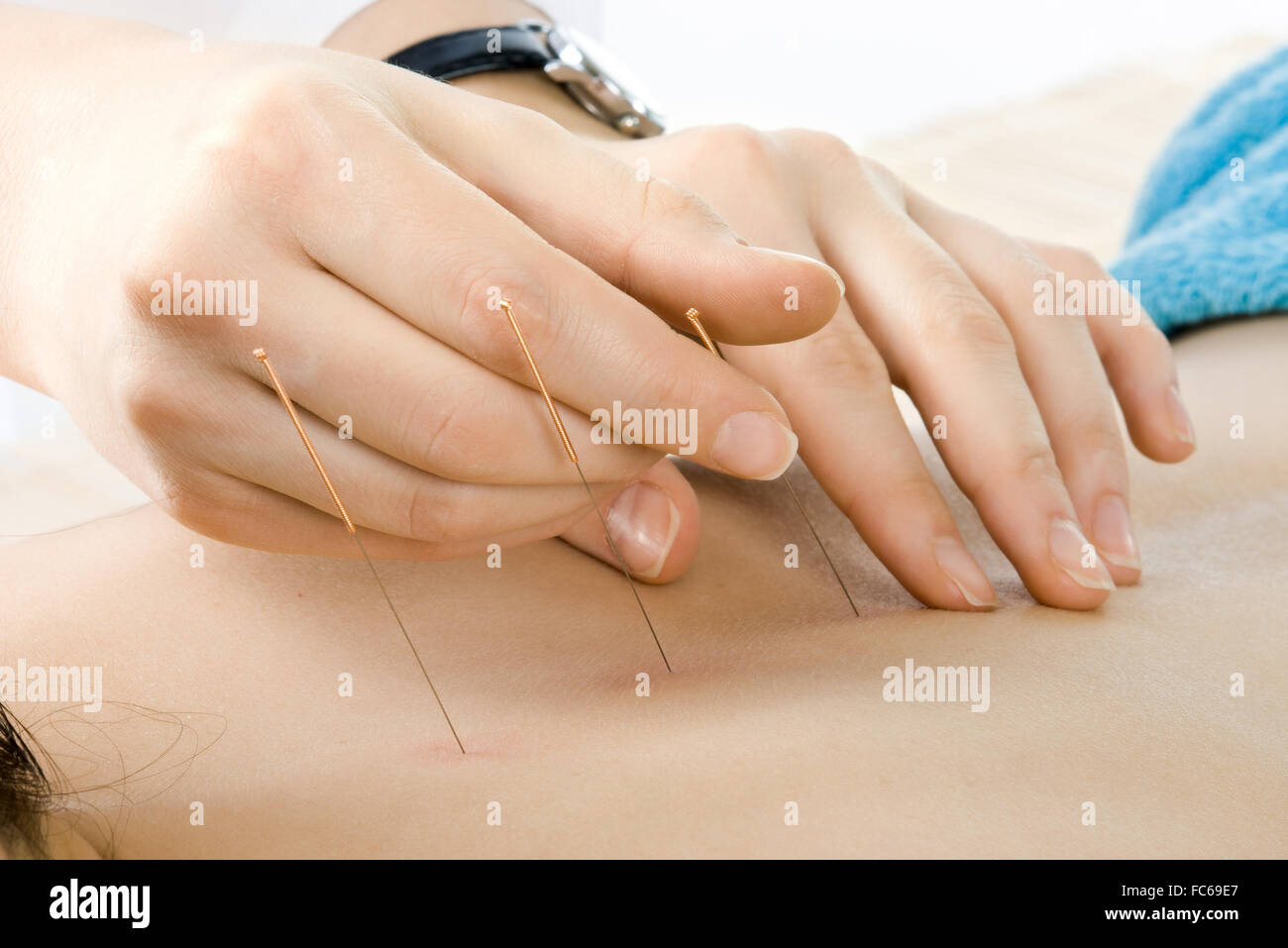 Akupunktur Stockfoto