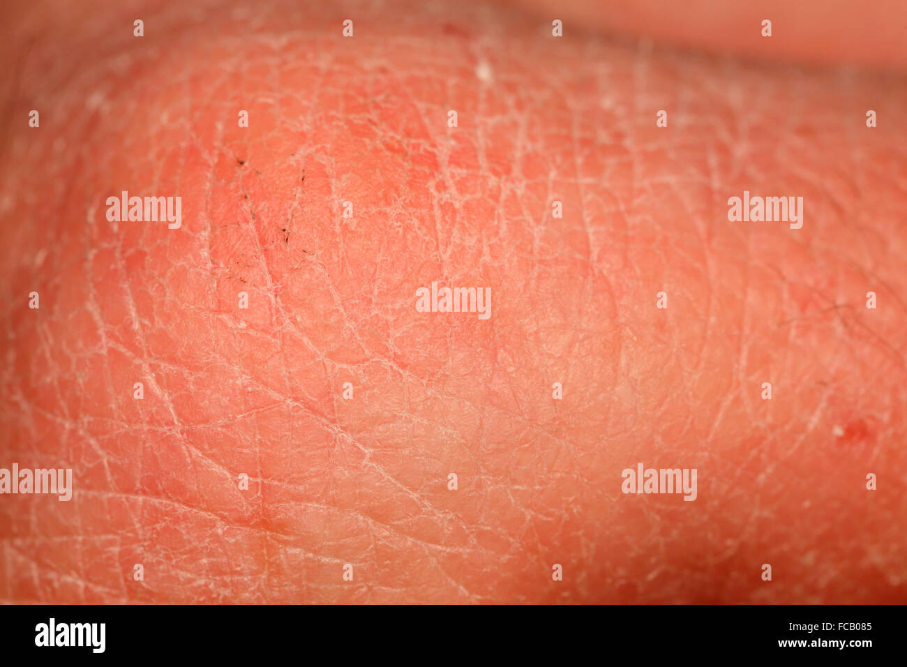 Trockene Haut. Stockfoto