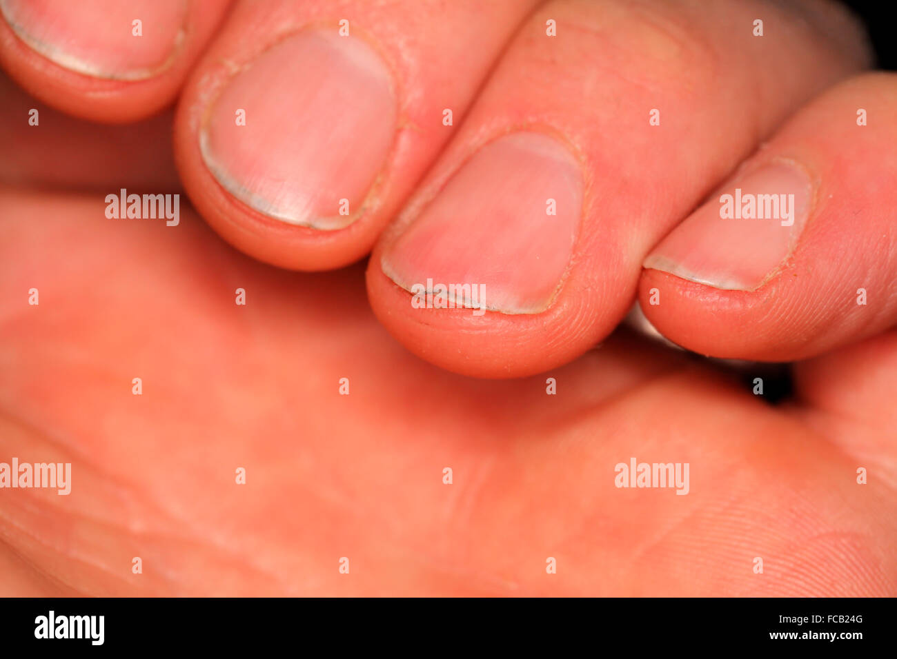 Verschmutzte, unregelmäßige Fingernägel. Stockfoto