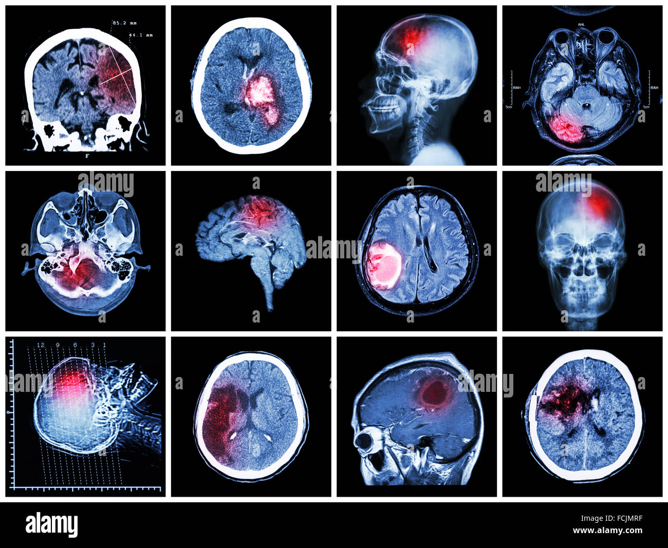 Sammlung von Erkrankung des Gehirns (CT und MRT des Gehirns: Hirninfarkt, Intrazerebrale Blutung, Hirntumor, basale zeigen Stockfoto