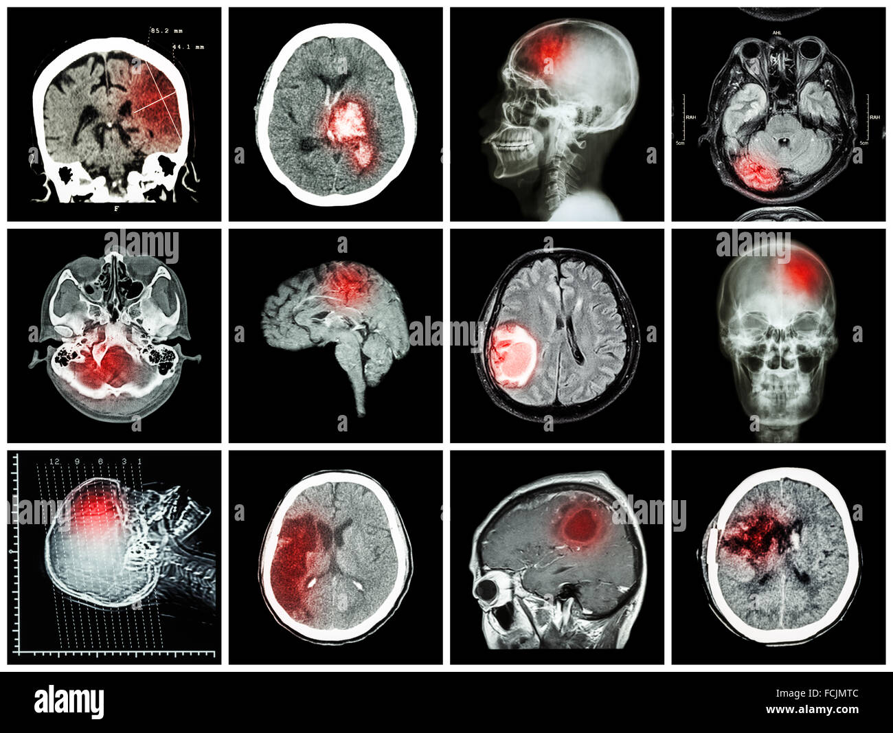 Sammlung von Erkrankung des Gehirns (CT und MRT des Gehirns: Hirninfarkt, Intrazerebrale Blutung, Hirntumor, basale zeigen Stockfoto