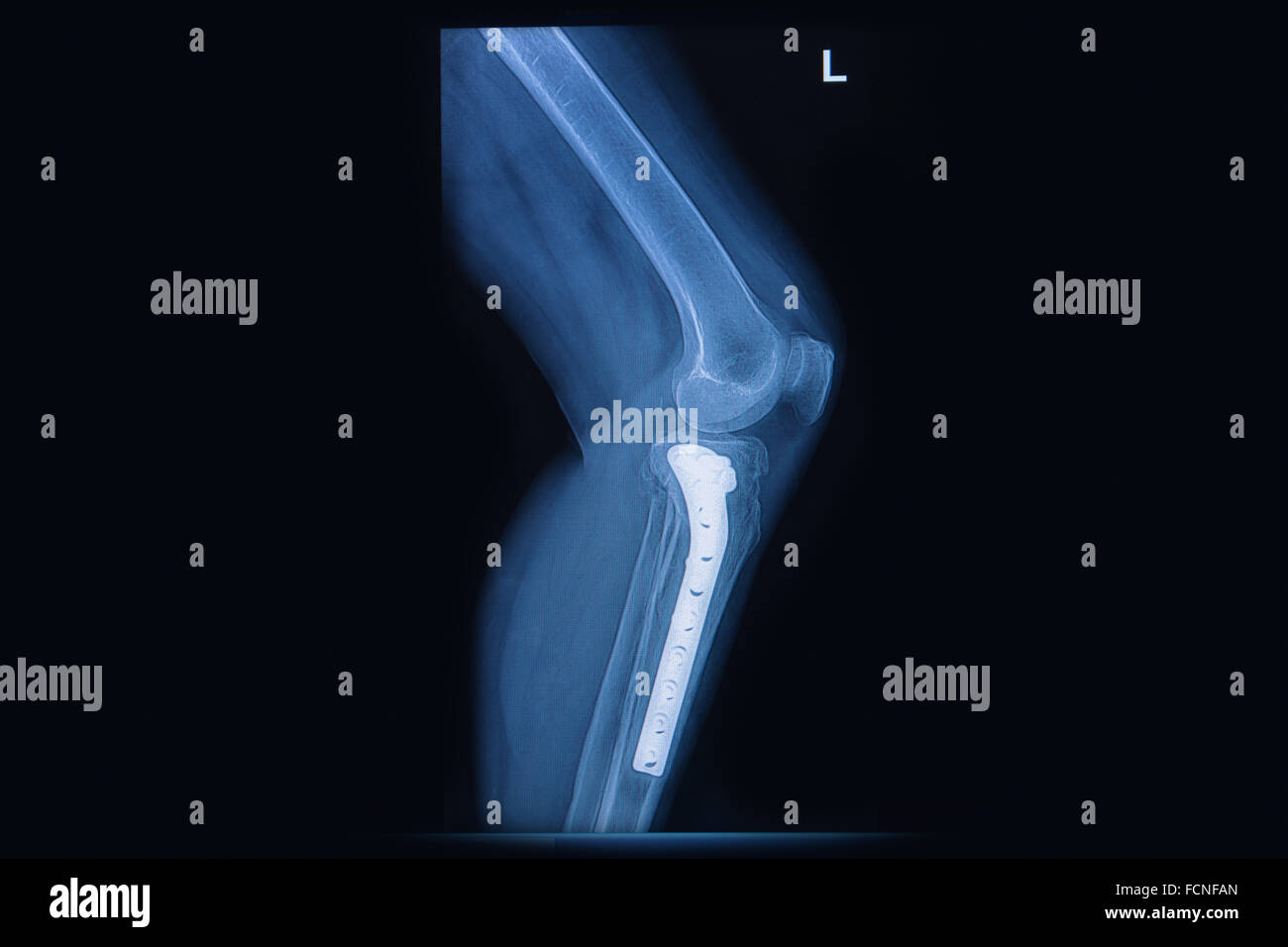 x-ray Bruch Tibia(leg bone). Schienbein Knochen mit internen durch Platte & Schraube fixiert Stockfoto