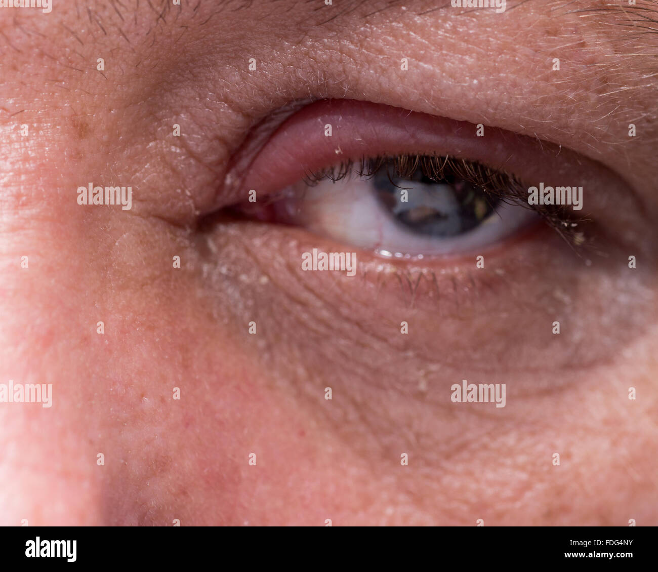 Augenentzündung mit geschwollenen Augenlid hautnah Stockfoto