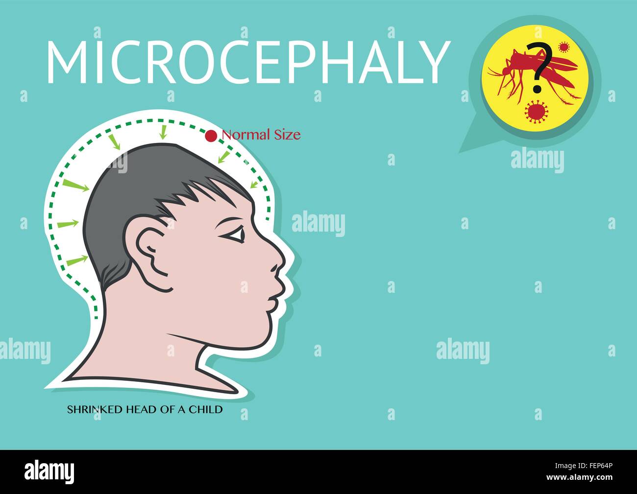 Mikrozephalie Abweichung aufgrund Zika Virus Stock Vektor