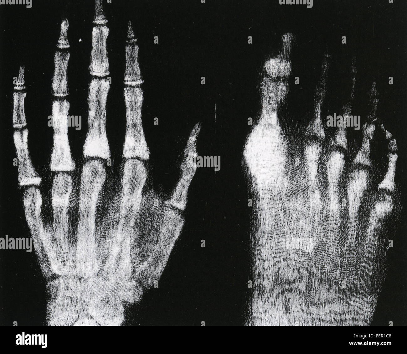 Deutscher Physiker WILHELM RONTGEN (1845-1923), der Röntgenstrahlen entdeckt. Eines seiner 1896 Fotos zeigen einen linken und rechten Fuß. Stockfoto