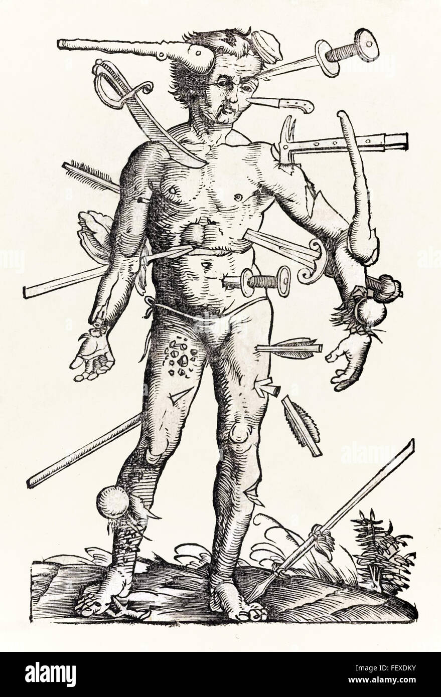 Wunde Mann Holzschnitt zugeschrieben Hans Wechtlin aus deutscher Chirurg Hans von Gersdorff Feldbuch der Chirurgie im Jahre 1517 veröffentlicht. Stockfoto