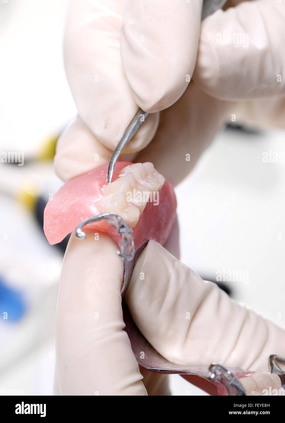 Teilprothesen auf einem Metall Bogen. Teilprothesen, Dental und Prothetik Stockfoto
