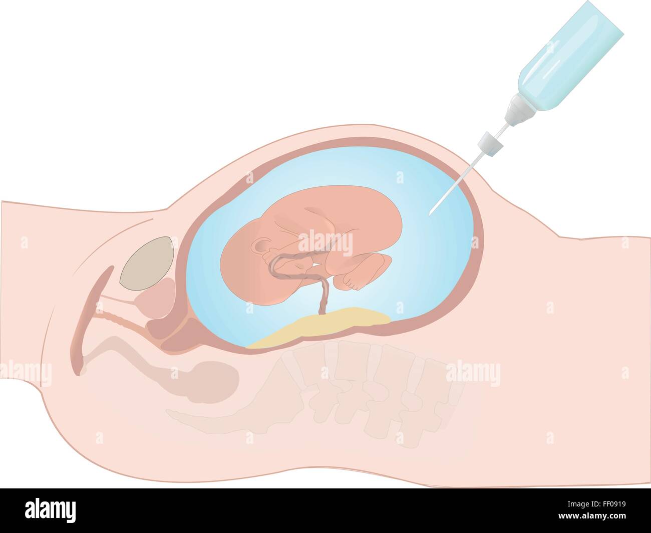 Amniotic Fluid Stockfotos und bilder Kaufen Alamy