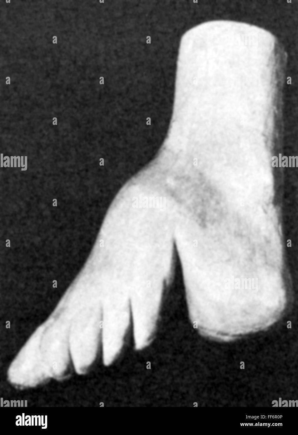 Medizin, Anatomie, Skelett / Knochen, Deformation eines chinesischen gebundenen Fußes, Modell, aus: 'Ärztliche Praxis', Band XL, Nummer 19, 5.3.1988, Additional-Rights-Clearences-not available Stockfoto