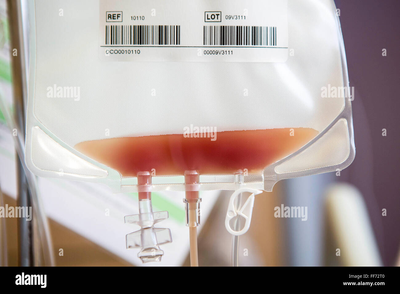 Die ersten paar Stammzellen von einem Spender gesammelt werden in einen Beutel für Blut-Krebs-Behandlung in der Klinik von London, London, Vereinigtes Königreich zu verwendende gepumpt.  Die Stammzellen sind getrennt und gesammelt von einer Bluttransfusion, die in der Regel 3 bis 4 Stunden dauert. Es ist ein komplexer Vorgang und erfordert eine sorgfältige Überwachung. Stockfoto