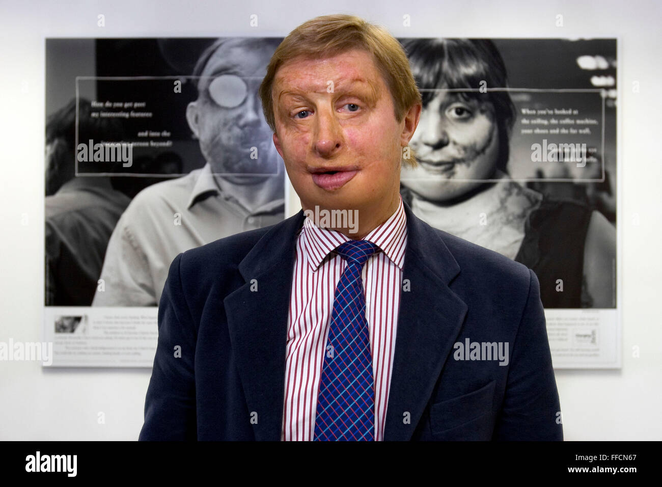 James Partridge, Direktor des Changing Faces. Wechselnden Gesichtern ist eine nationale Wohltätigkeitsorganisation, die unterstützt und vertritt Menschen, die Entstellung im Gesicht oder Körper aus irgendeinem Grund haben. Stockfoto