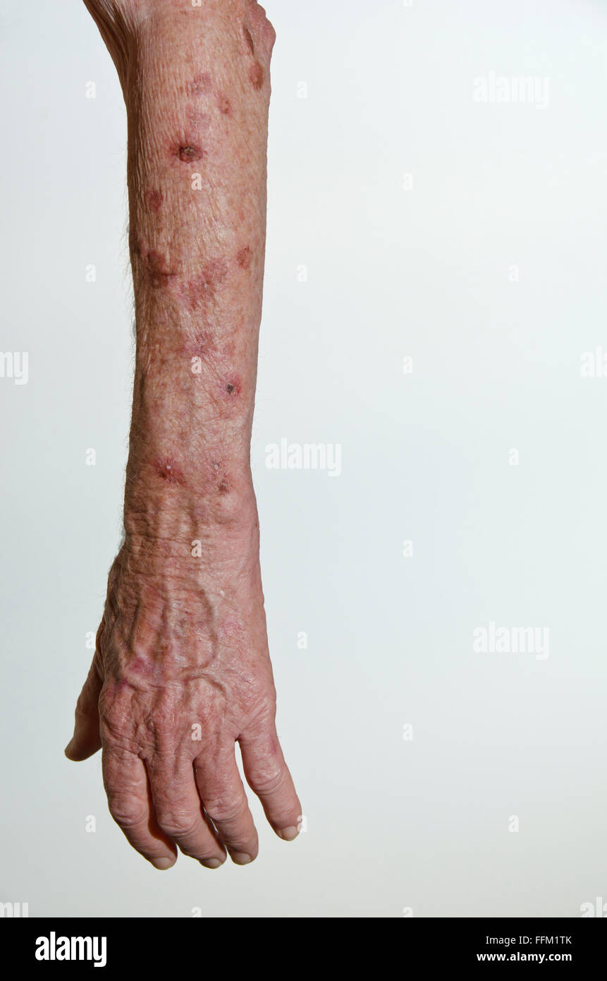 Ältere männliche Arm nach Hautkrebs mit flüssigem Stickstoff eingefroren Stockfoto