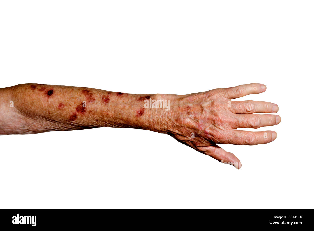 Sonne beschädigte Arm zeigt Hautkrebs behandelt mit flüssigem Stickstoff Stockfoto