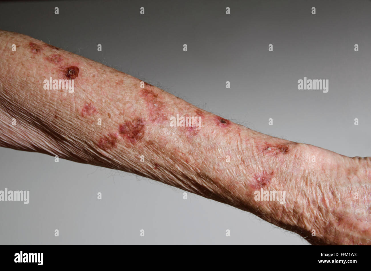 Ältere männliche Arm nach Hautkrebs mit flüssigem Stickstoff Einfrieren Stockfoto
