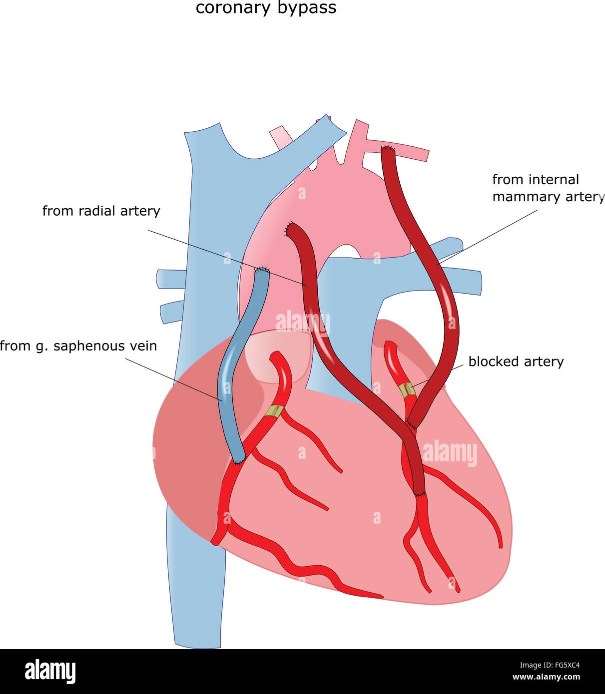 Coronary Bypass Stockfotos & Coronary Bypass Bilder Alamy