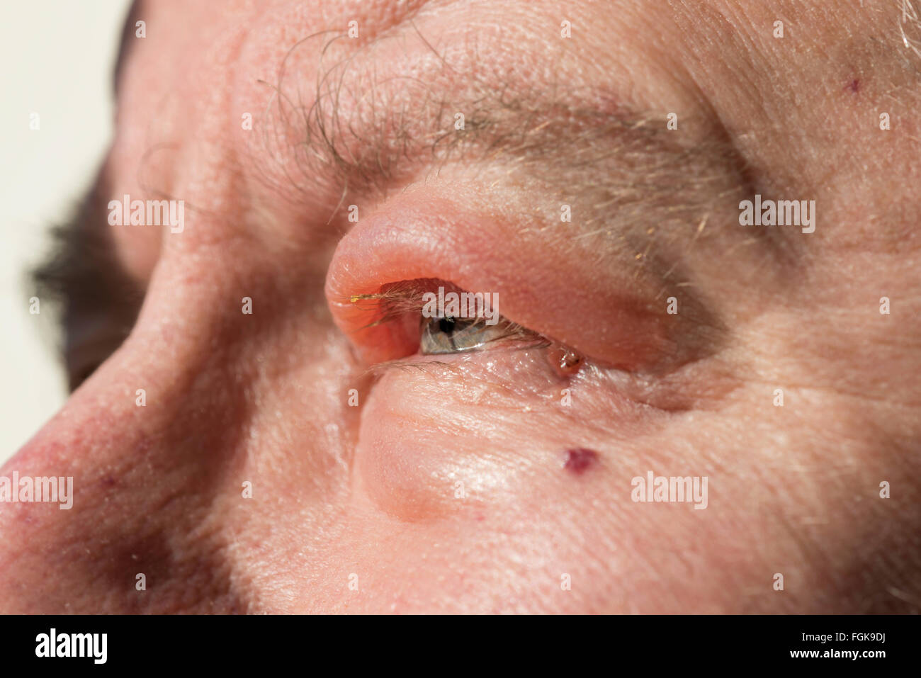 Blepharitis Entzündung des Augenlids. Stockfoto