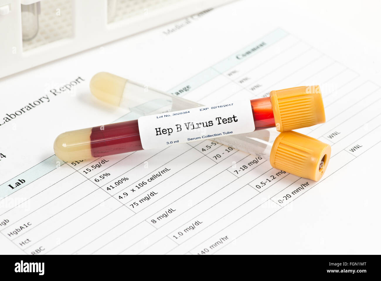 Hepatitis testen Blut Analyse Sammelröhrchen mit Blut Sammlung versorgt. Etiketten und Docs von Fotograf erstellt. Stockfoto