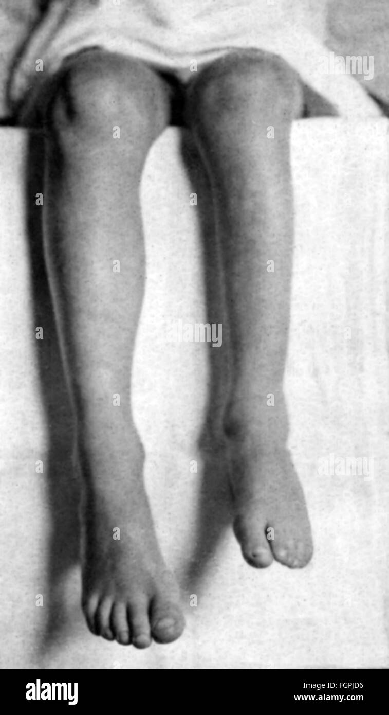 Medizin, Krankheit, Poliomyelitis, Atrophie und Verkürzung eines