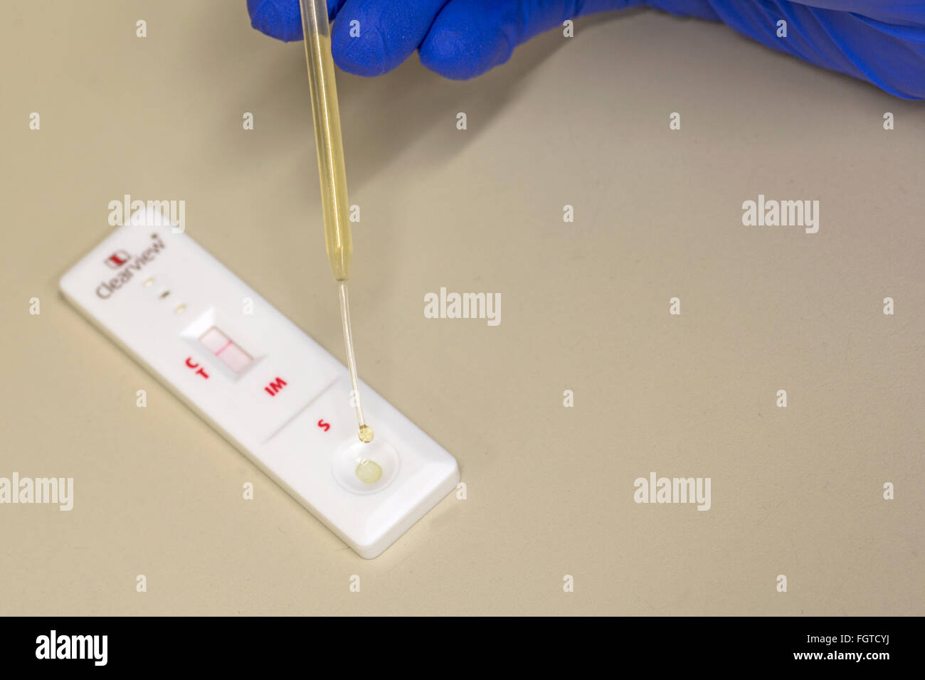 Infektiöse Mononukleose in einem Krankenhaus-Pathologie-Labor testen. Stockfoto