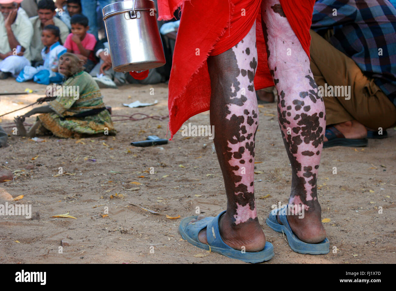 Menschen mit Vitiligo/Depigmentierung auf seine Beine in Pushkar, Indien Stockfoto